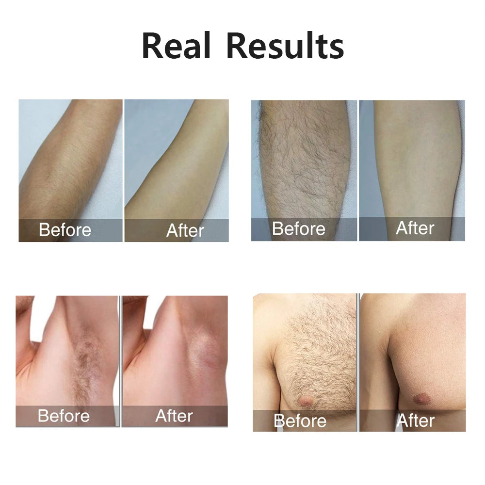 Permanent Hair Removal for Women’s Body and Bikini Line