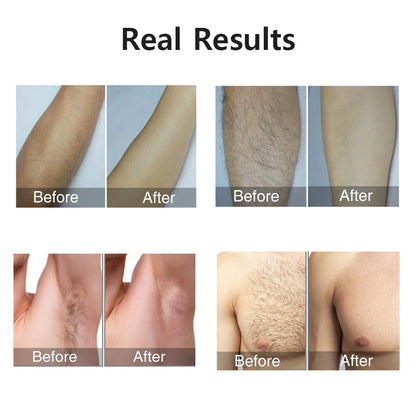 Permanent Hair Removal for Women’s Body and Bikini Line
